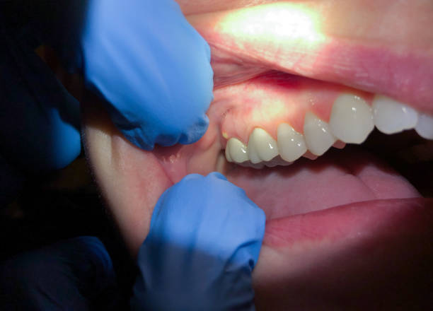 Best Emergency Dentist for Knocked-Out Tooth in Remgton, IN